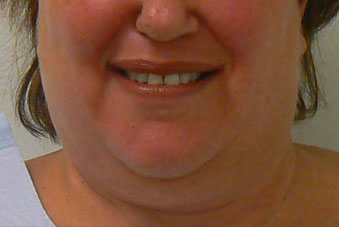 face_neck2before