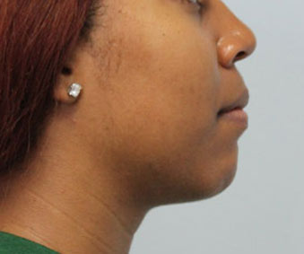 Before_After_BodycareDoctor_Face-Neck3A