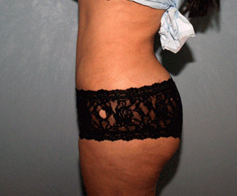 abdomen6after