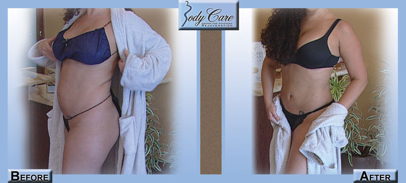 Smart Lipo-Before-After